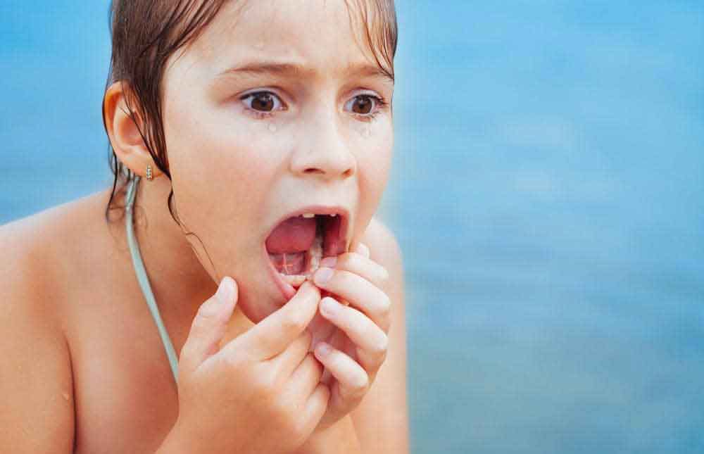 Rotura de dientes en niños: ¿qué hacer? 