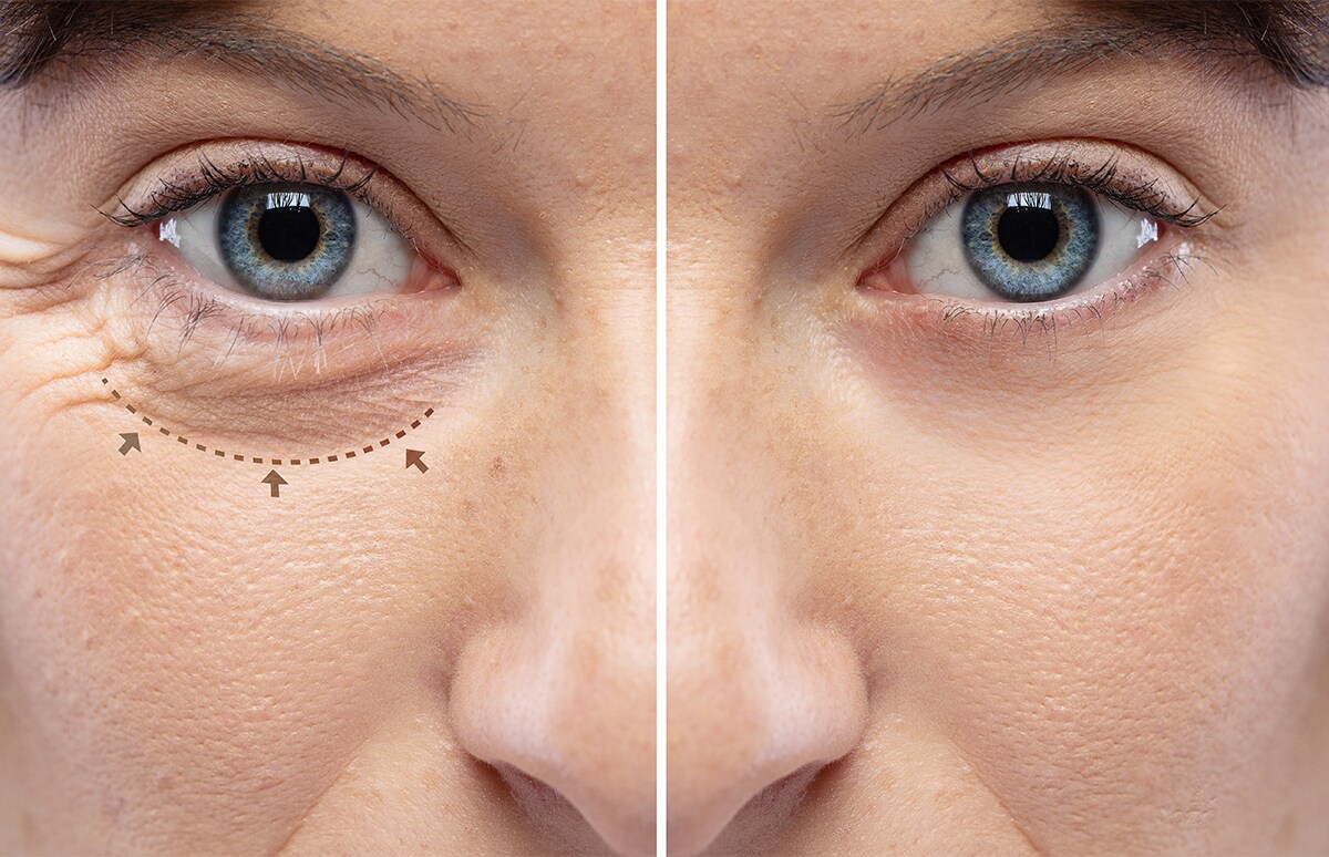 ¿Pensando en hacerte una blefaroplastia? ¿Podría estar cubierta por tu seguro médico? Te lo contamos.