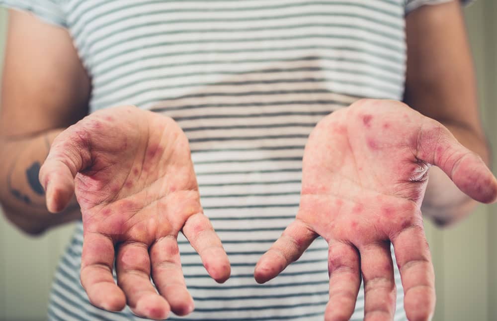 Primeros síntomas de varicela en adultos